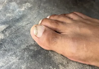 Gingerbread Nails Fungus, symptoms and treatment