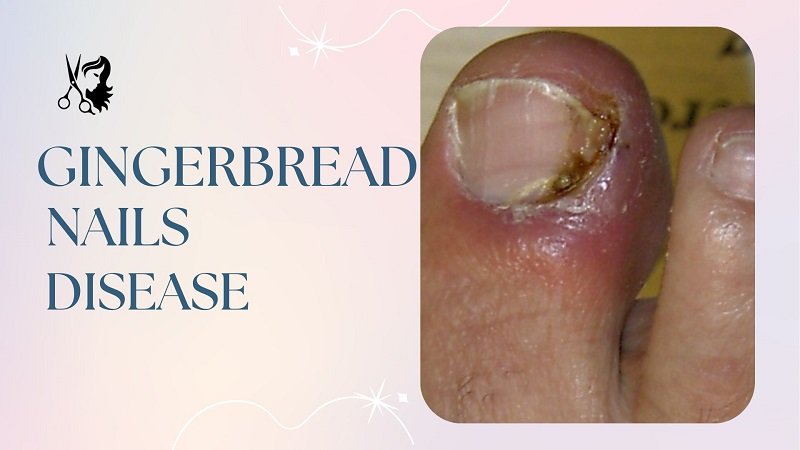 Gingerbread Nails Disease