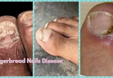 Gingerbread Nails Disease