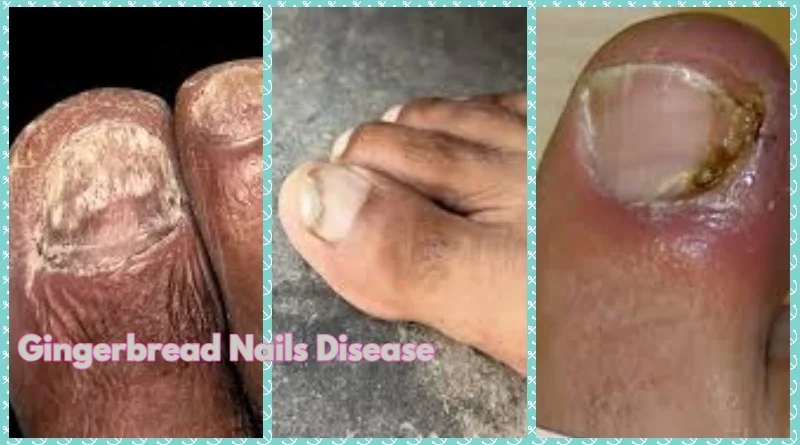 Gingerbread Nails Disease