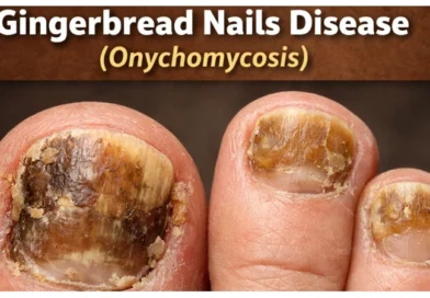 Gingerbread Nails Disease